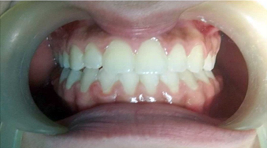 بعد تقويم وعلاج الاسنان بمركز دكتور ايمن الغمراوى -تركيب وتجميل الاسنان 2